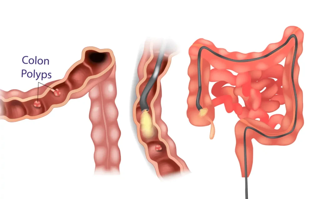 How to Prepare for a Colonoscopy