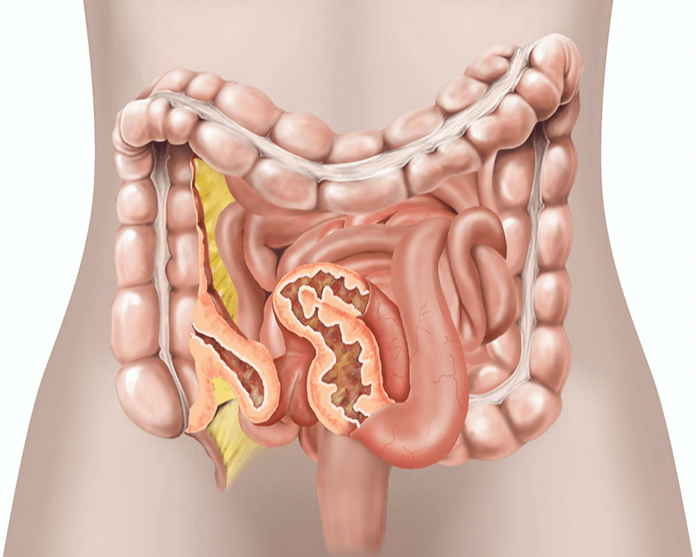 How Close Are We to a Cure for Crohn’s Disease?